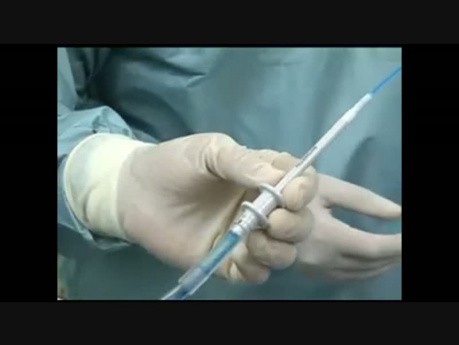 Intragastric Balloon Explant
