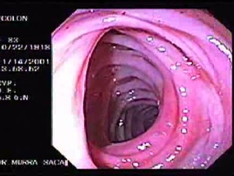 Diverticular Disease - Hemorrhage (14 of 15)