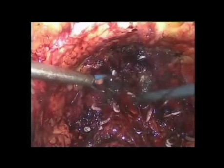 Glubran 2 as Haemostatic and Reinforcing Agent During Urologic Cystectomy