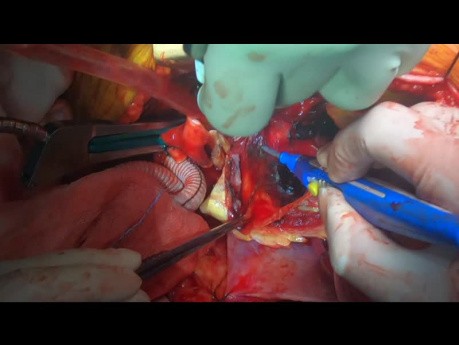 Ruptured Aortic Aneurysm of the Arch and Ascending Aorta