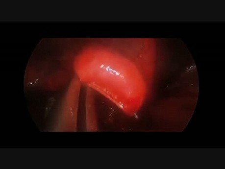 Rescue Surgery after High Doses of Chemo-radiotherapy – Bronchoplasty and Bleeding Control