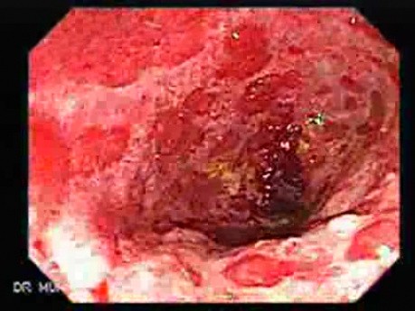 Colonic Lymphoma (6 of 6)