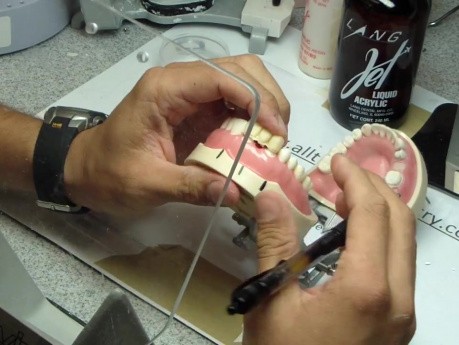 Anterior Bridge Preparation, Part 6- Right Before Relining Jet Provisional