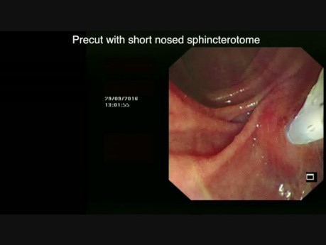 The Fishy ERCP