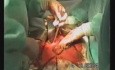 Gastric Cancer Surgery - Stomach Stump Extirpation
