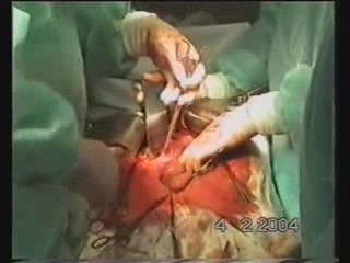 Gastric Cancer Surgery - Stomach Stump Extirpation
