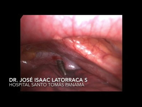 White Weapon Removal from the Neck by Video-assisted Thoracoscopic Surgery (VATS)