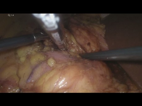Simultaneous Laparoscopic Right Adrenalectomy and Right Renal Tumorectomy