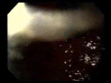 Endoscopy of Mallory Weiss Tear - The Second Endoscopic Assessment
