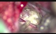 Vestibular Schwannoma (Acoustic Neuroma) Removal Using a Retrosigmoid Approach w/o Retractor