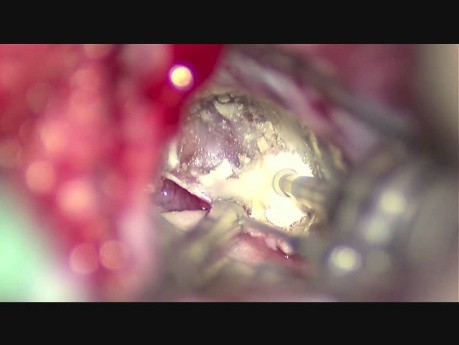 Vestibular Schwannoma (Acoustic Neuroma) Removal Using a Retrosigmoid Approach w/o Retractor