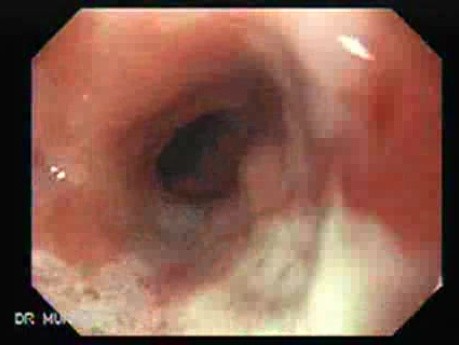 Esophagus - Pneumatic Dilation for Achalasia - Follow Up a Year After Procedure