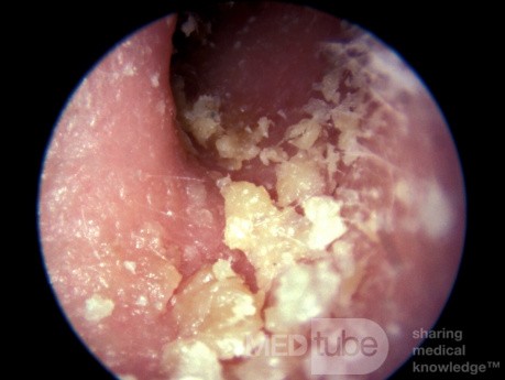 Psoriasis External Canal
