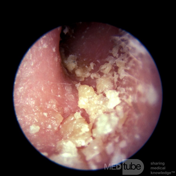 Psoriasis External Canal