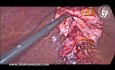 Laparoscopic Cholecystectomy in Impacted Infundibular / Cystic Duct Stone