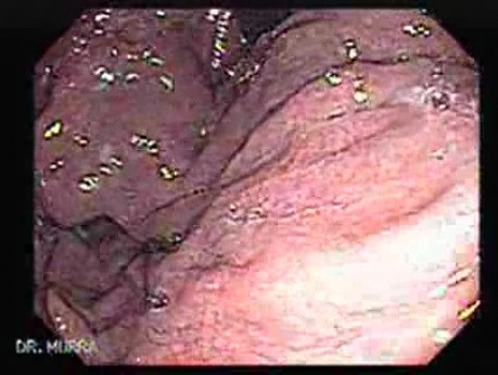 Gastric Varices (5 of 25)