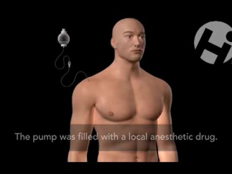 Pain Pump