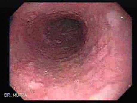 Glycogenic Acanthosis of the Esophagus - Endoscopic Examination