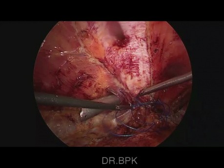 Laparoscopic E-Tep Rives Stoppa Repair for Multiple Hernia