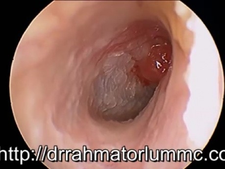 Attic Polyp
