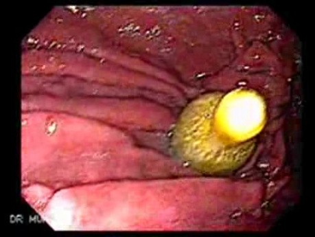 Percutaneous Endoscopic Gastrostomy - Inner View