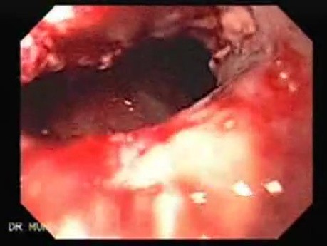Synchronous Cancer Gastric and Esophageal (6 of 9 )