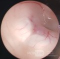 Endoscopic Third Ventriculostomy in a Benign Case of Aicardi Syndrome with Obstructive Hydrocephalus and Chiari Malformation type 1