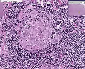Sarcoidosis