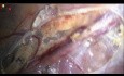 How to Dissect for Artery Preserving Laparoscopic Varicocelectomy