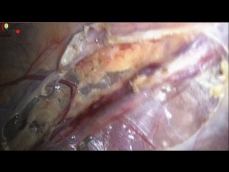 How to Dissect for Artery Preserving Laparoscopic Varicocelectomy