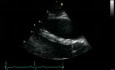 Echocardiography - Parasternal View -  Normal Study