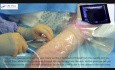 Venous Access Made Easy Video (5)