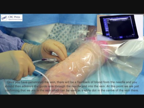 Venous Access Made Easy Video (5)
