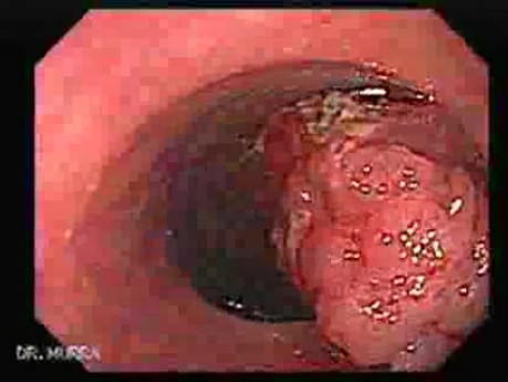Large Tubulo-Villous Adenoma (1 of 6)