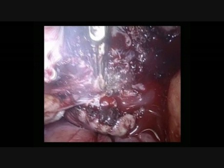 Laparoscopic Myomectomy