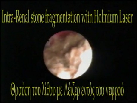 RIRS + Laser Stone Fragmenation