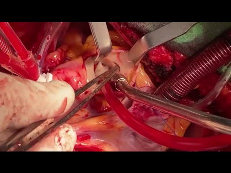 Patient with Monocuspid Aortic Valve and Distal Arch Hypoplastic 