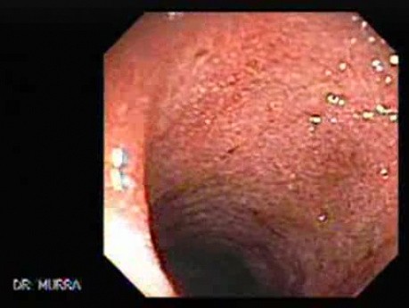 Ulcerative Colitis Complicating Pseudomembranous Colitis (1 of 4)