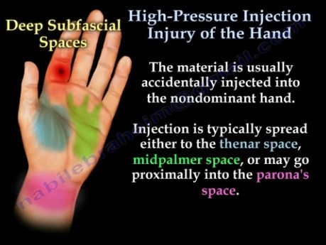 Hand High-Pressure Injection Injury 