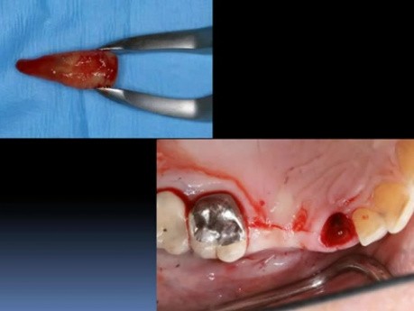 Ridge Augmentation 101 