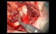 Canal – Wall – Down Retympanoplasty With SC (Short Columella) Ossiculoplasty 