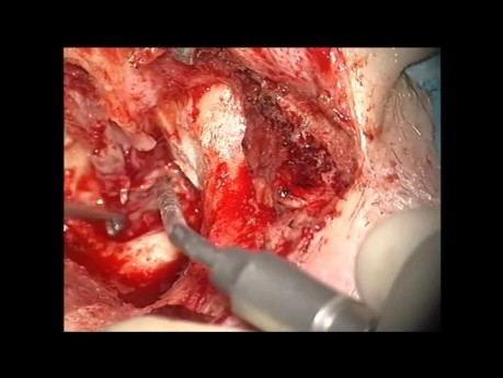 Canal – Wall – Down Retympanoplasty With SC (Short Columella) Ossiculoplasty 