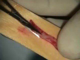 Connective Tissue Grafting 