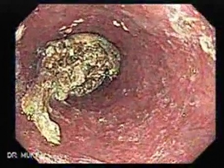 Esophageal Achalasia - Impaction of foreign bodies (piece of meat) (1 of 5)