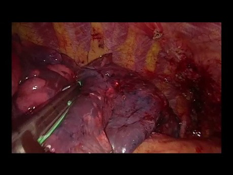 Subxiphoid Uniportal VATS RUL in a Big Tumor with Tracheal Bronchus