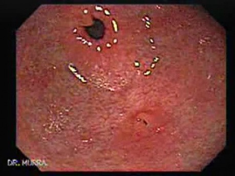 Heterotopic pancreas