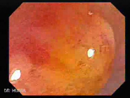Non Familial Juvenile Polyposis Of The Colon (15 of 37)