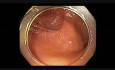 Colonoscopy - Cecal EMR Scar