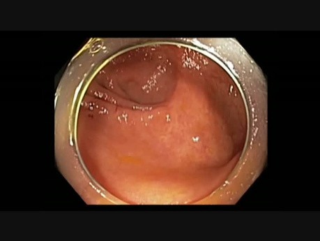 Colonoscopy - Cecal EMR Scar
