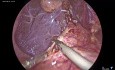Laparoscopic Choledochal Cyst Excision with Hepaticojejunostomy